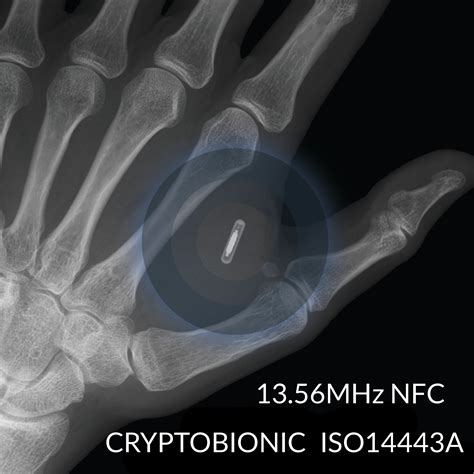 nfc chip implants